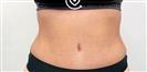 Liposuction - Cayra Clinic