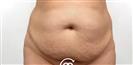 Liposuction - Cayra Clinic