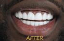 Porcelain Veneers - Cayra Clinic