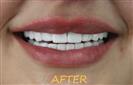 Porcelain Veneers - Cayra Clinic