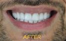 Porcelain Veneers - Cayra Clinic
