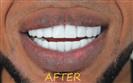 Porcelain Veneers - Cayra Clinic