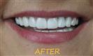 Porcelain Veneers - Cayra Clinic