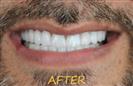 Porcelain Veneers - Cayra Clinic