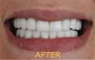 Porcelain Veneers - Cayra Clinic