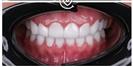 Porcelain Veneers - Cayra Clinic