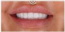 Porcelain Veneers - Cayra Clinic