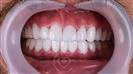 Porcelain Veneers - Cayra Clinic