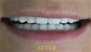 Porcelain Veneers - Cayra Clinic