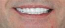 Porcelain Veneers - Cayra Clinic