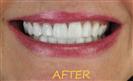 Porcelain Veneers - Cayra Clinic
