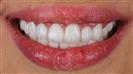 Porcelain Veneers - Cayra Clinic
