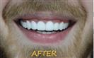 Porcelain Veneers - Cayra Clinic