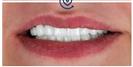 Porcelain Veneers - Cayra Clinic