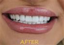 Porcelain Veneers - Cayra Clinic