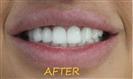 Porcelain Veneers - Cayra Clinic