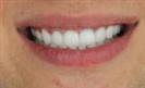 Porcelain Veneers - Cayra Clinic