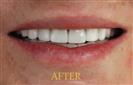 Porcelain Veneers - Cayra Clinic