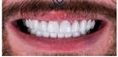 Porcelain Veneers - Cayra Clinic