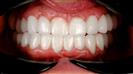 Porcelain Veneers - Cayra Clinic