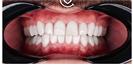 Porcelain Veneers - Cayra Clinic