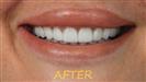 Porcelain Veneers - Cayra Clinic