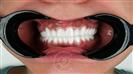Porcelain Veneers - Cayra Clinic