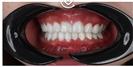 Porcelain Veneers - Cayra Clinic