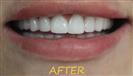 Porcelain Veneers - Cayra Clinic