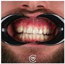 Porcelain Veneers - Cayra Clinic