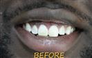 Porcelain Veneers - Cayra Clinic