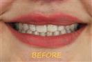 Porcelain Veneers - Cayra Clinic