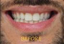 Porcelain Veneers - Cayra Clinic