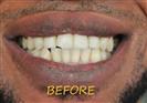 Porcelain Veneers - Cayra Clinic