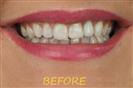 Porcelain Veneers - Cayra Clinic