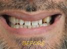 Porcelain Veneers - Cayra Clinic