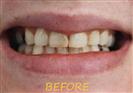 Porcelain Veneers - Cayra Clinic