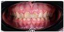 Porcelain Veneers - Cayra Clinic