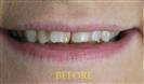 Porcelain Veneers - Cayra Clinic