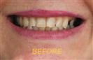 Porcelain Veneers - Cayra Clinic