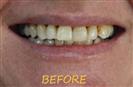 Porcelain Veneers - Cayra Clinic