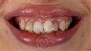Porcelain Veneers - Cayra Clinic