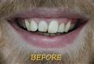 Porcelain Veneers - Cayra Clinic