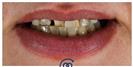 Porcelain Veneers - Cayra Clinic