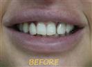 Porcelain Veneers - Cayra Clinic