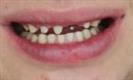 Porcelain Veneers - Cayra Clinic