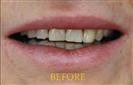 Porcelain Veneers - Cayra Clinic