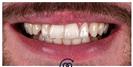 Porcelain Veneers - Cayra Clinic