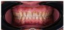 Porcelain Veneers - Cayra Clinic