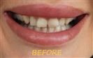 Porcelain Veneers - Cayra Clinic